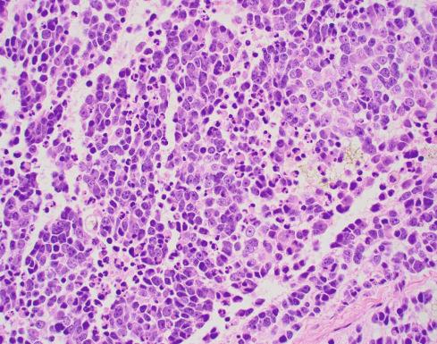 Fig. 28.5, MYCN -amplified neuroblastoma (schwannian stroma-poor), poorly differentiated subtype with a high MKI. MYCN -amplified tumor typically demonstrates a histologic appearance of undifferentiated or poorly differentiated subtype with markedly increased mitotic and karyorrhectic activity. Note that nucleolar hypertrophy (formation of one to a few prominent nucleoli) is often observed in neuroblastomas with MYC-family protein (MYCN or MYC) overexpression.