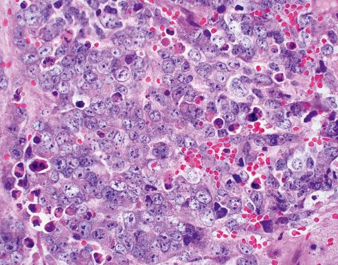 Fig. 28.6, Neuroblastoma (schwannian stroma-poor), undifferentiated subtype with large cell histology. Tumor is composed of undifferentiated cells with enlarged and open nuclei containing one to a few prominent nucleoli (nucleolar hypertrophy).