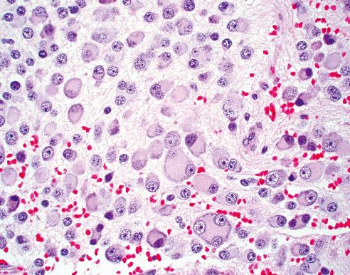 Fig. 28.7, Neuroblastoma (Schwannian Stroma-Poor), Differentiating Subtype.