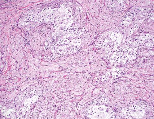 Fig. 28.8, Ganglioneuroblastoma, Intermixed (Schwannian Stroma-Rich).