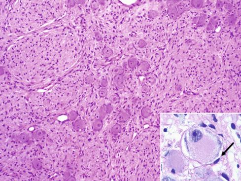 Fig. 28.9, Ganglioneuroma (Schwannian Stroma-Dominant).