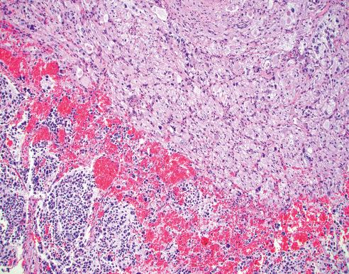 Fig. 28.10, Ganglioneuroblastoma, Nodular (Composite, Schwannian Stroma-Rich/Stroma-Dominant and Stroma-Poor).