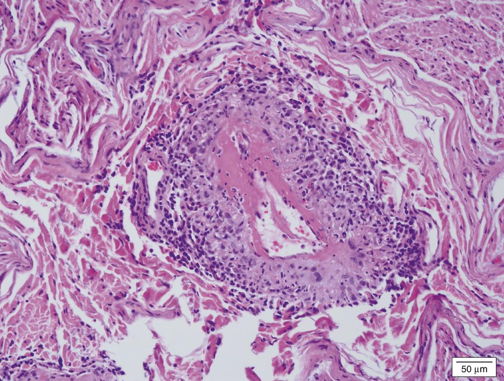 FIGURE 388-2, Nerve biopsy from a patient with mononeuritis multiplex reveals vasculitis involving the full thickness of the vessel wall with fibrinoid necrosis.