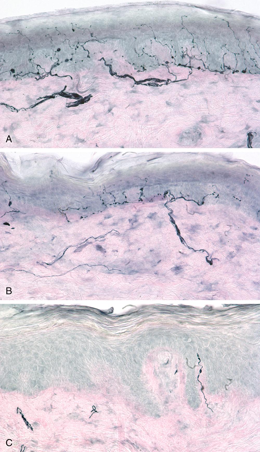 FIGURE 388-3, Skin biopsies from the proximal thigh ( A ), distal thigh ( B ), and distal leg ( C ) of a patient with suspected small fiber neuropathy were stained with PGP 9.5, a pan-axonal marker.