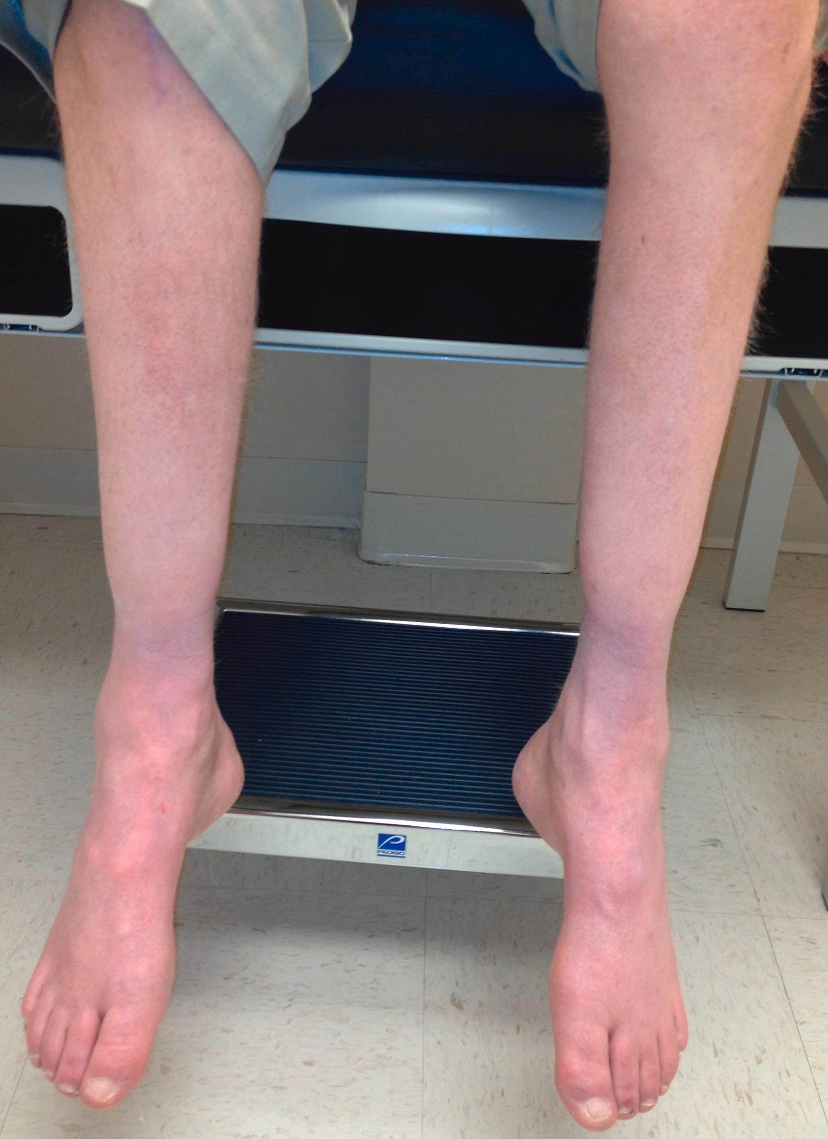 FIGURE 388-4, Distal leg atrophy and high arched feet (pes cavus) in a patient with Charcot-Marie-Tooth disease.