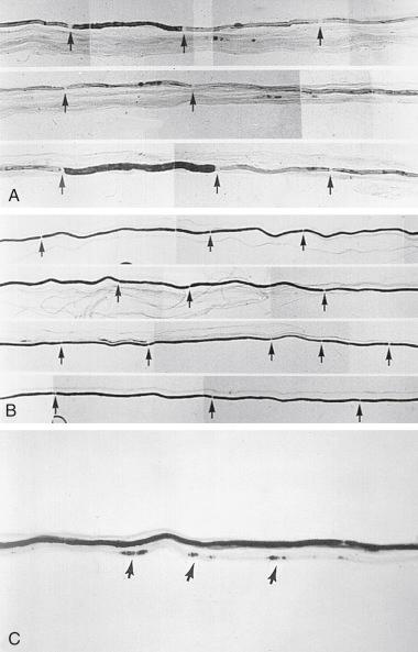 Figure 6-3, Teased nerve fiber preparation. A, Segmental demyelination. B, Remyelination. C, Axonal degeneration.