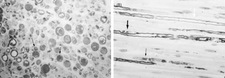 Figure 19.1, ( A ) Metachromatic leukodystrophy: Cross-section of sural nerve demonstrating metachromatic material (arrows) and irregular myelin sheaths. Methylene blue. ×400. ( B ) Metachromatic leukodystrophy: Longitudinal section of sural nerve demonstrating metachromatic material within Schwann cell cytoplasm (black arrows) and narrowing of myelin sheath (white arrow). Cresyl violet. ×400.