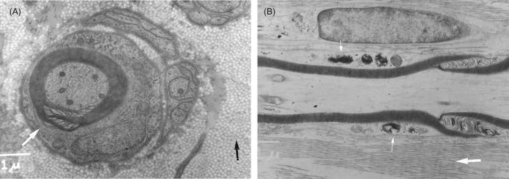 Figure 19.2, ( A ) Metachromatic leukodystrophy: Electron micrograph of sural nerve in cross-section, demonstrating excess interstitial collagen (black arrow) and remyelination (white arrow). ( B ) Metachromatic leukodystrophy: Electron micrograph of sural nerve in longitudinal section demonstrating granular inclusions in Schwann cell cytoplasm (small white arrows) and excess interstitial collagen (large white arrow). ×12,000.