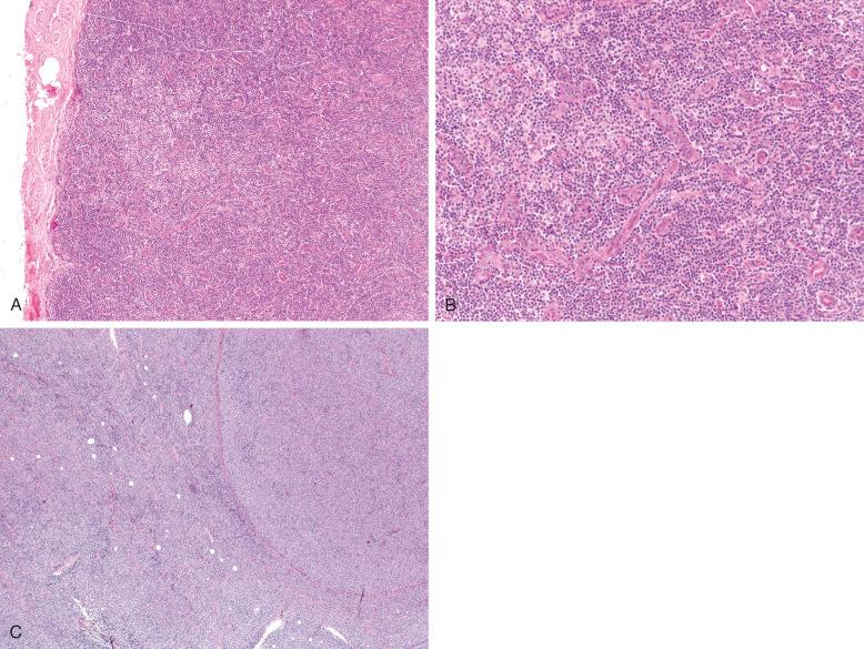 Figure 35-1, Patterns of lymph node involvement in peripheral T-cell lymphoma, not otherwise specified.