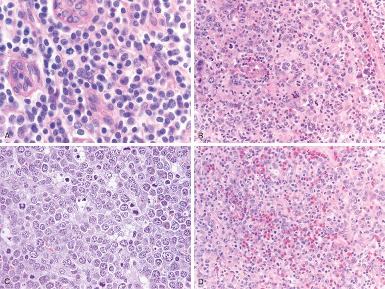 Figure 35-2, Cytologic spectrum of peripheral T-cell lymphoma, not otherwise specified (PTCL, NOS).