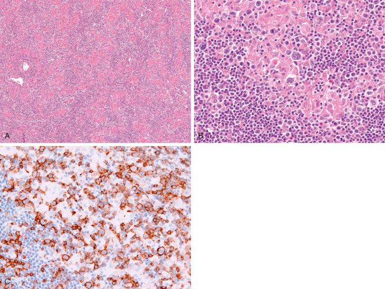 Figure 35-4, Lennert's lymphoma.