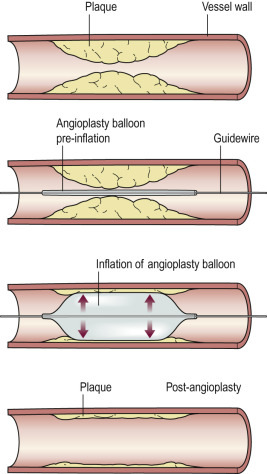 Fig. 80.1, Diagram of Angioplasty.