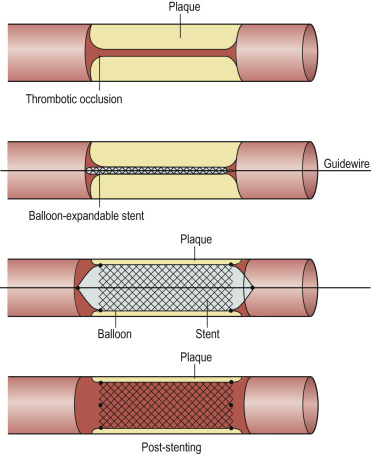 Fig. 80.2, Diagram of Stenting.