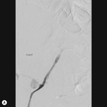 Fig. 80.3, Covered Stent for Iatrogenic Iliac Haemorrhage Post-Surgery.