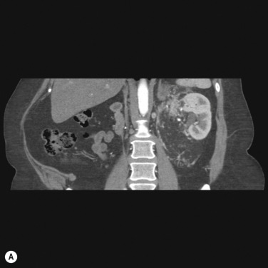 Fig. 80.4, Embolisation of Angiomyolipoma.