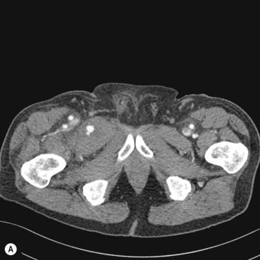 Fig. 80.6, Embolisation of Bleeding Lower Limb Artery.