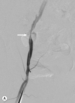 Fig. 80.8, Iliac Angioplasty.