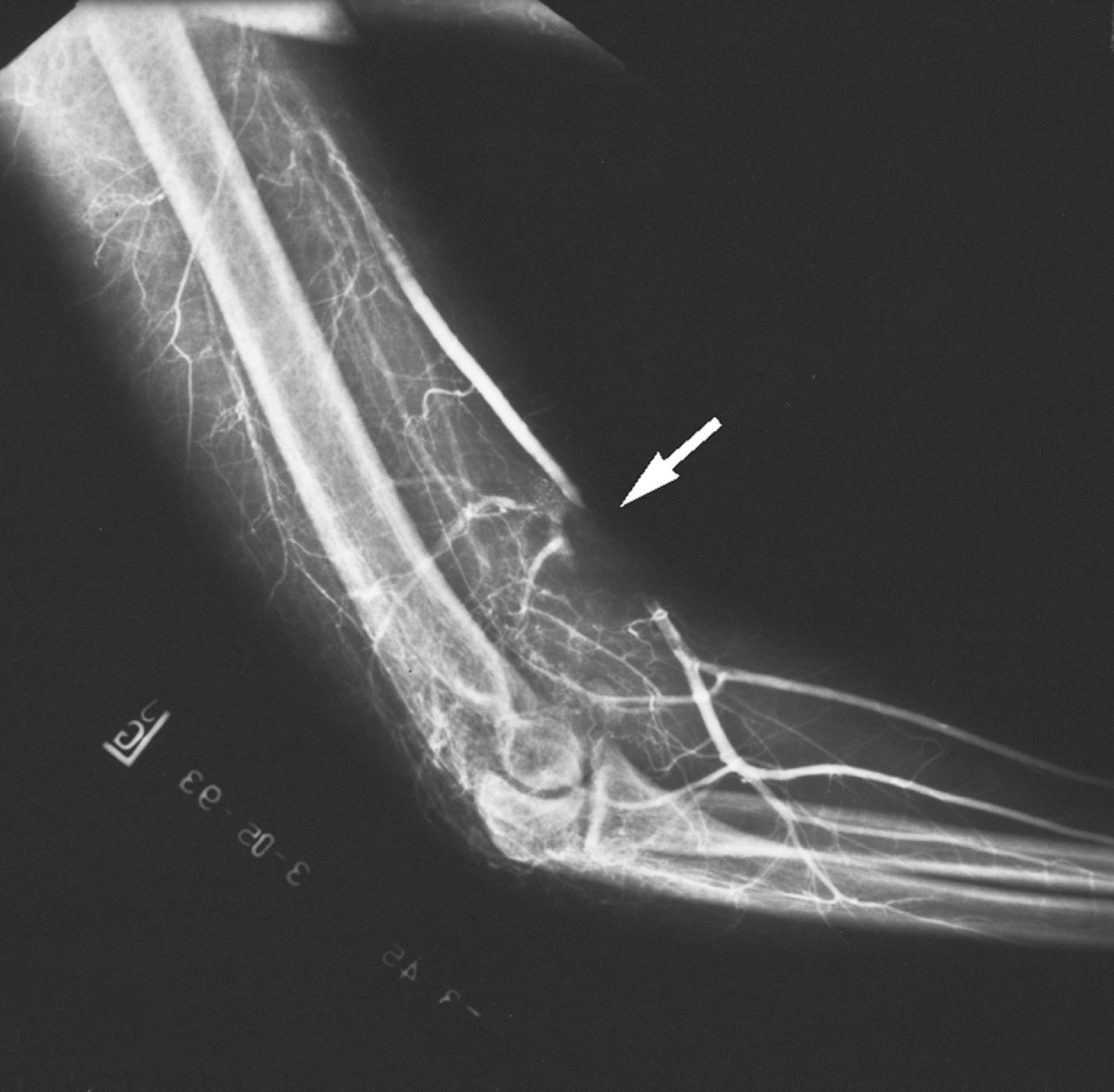 Fig. 40.3, Complete thrombosis (arrow) of the distal brachial artery after reduction of a posterior elbow dislocation.