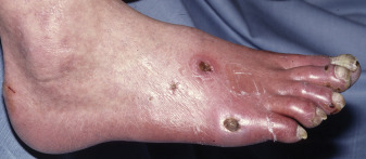 Fig. 26.1, Skin ulcers of the foot, secondary to chronic ischemia. Note the dry, scaly skin; rubor (red discoloration of the forefoot); and the well-demarcated, dry ulcers.