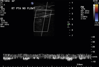 Fig. 26.11, Severe calcification of a posterior tibial artery. Due to poor penetration of ultrasound through the calcium, the artery may appear to be occluded when there is flow present.