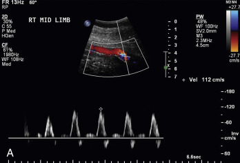 Fig. 26.4, (A) Normal, triphasic duplex waveform. (B) Normal, triphasic duplex waveform. The first phase starts with forward acceleration of the blood, secondary to contraction of the left ventricle. (C) Normal, triphasic duplex waveform. The first phase finishes with continued forward flow that decelerates as the left ventricle relaxes. (D) Normal, triphasic duplex waveform. In the second phase, flow is reversed, as the arterial pressure wave is reflected off the resistance vessels. (E) Normal, triphasic duplex waveform. In the third phase, flow is again in the forward direction, as the aortic root recoils and propels the blood forward.