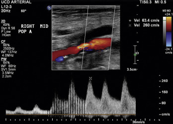 Fig. 26.6, Greater than 50% stenosis of the popliteal artery, with quadrupling of the peak systolic velocity and turbulent flow.