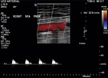 Fig. 26.7, Low-velocity, high-resistance arterial waveforms proximal to a severe stenosis of the superficial femoral artery.