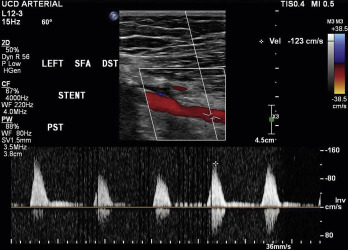 Fig. 26.8, Turbulent, monophasic waveforms distal to a significant stenosis of the superficial femoral artery.