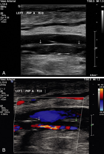 Fig. 26.9, B-mode (A) and color flow (B) images of calcified plaque and a narrow lumen of the popliteal artery.