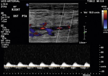 Fig. 26.10, Monophasic, low-velocity flow in the posterior tibial artery, distal to an occlusion.