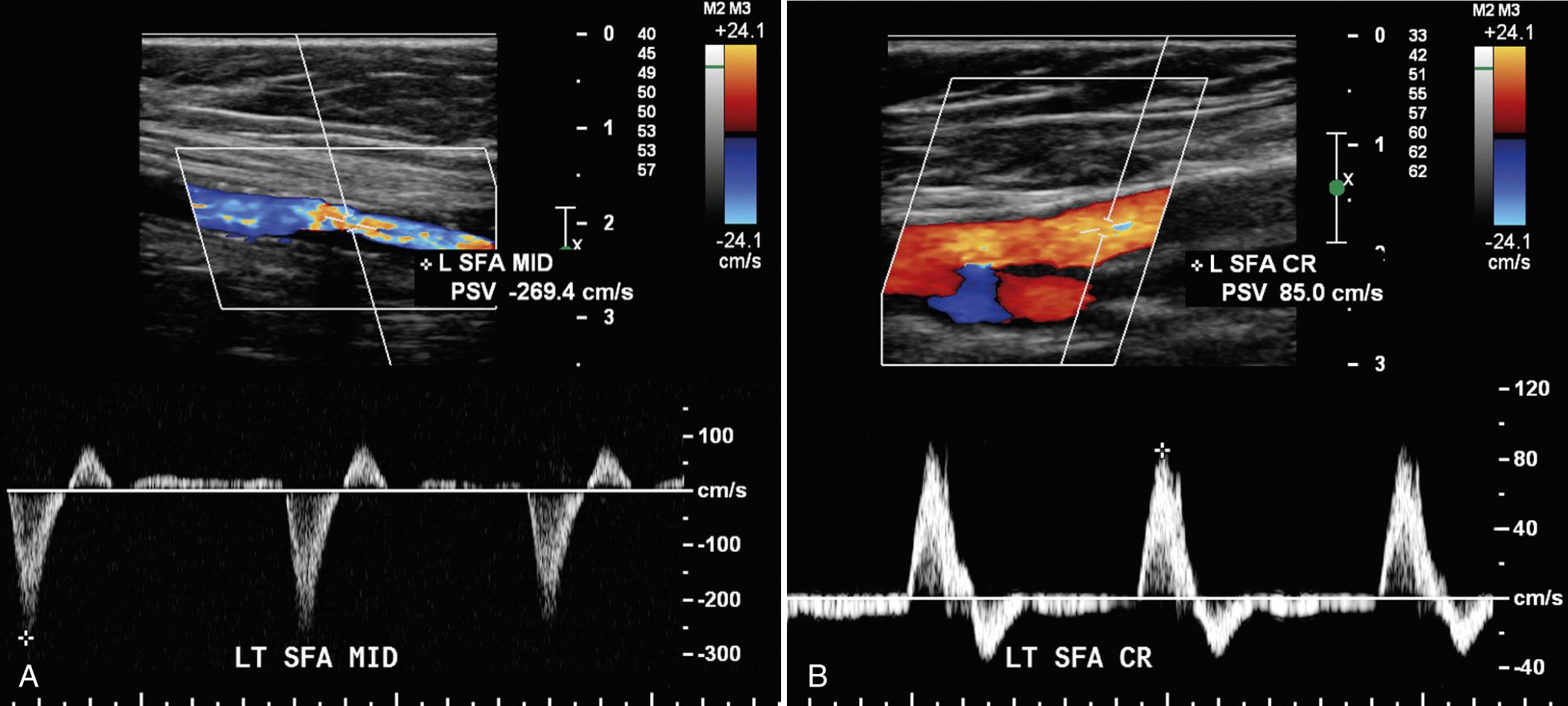 FIG. 27.11, Superficial Femoral Artery (SFA) With >70% Stenosis.