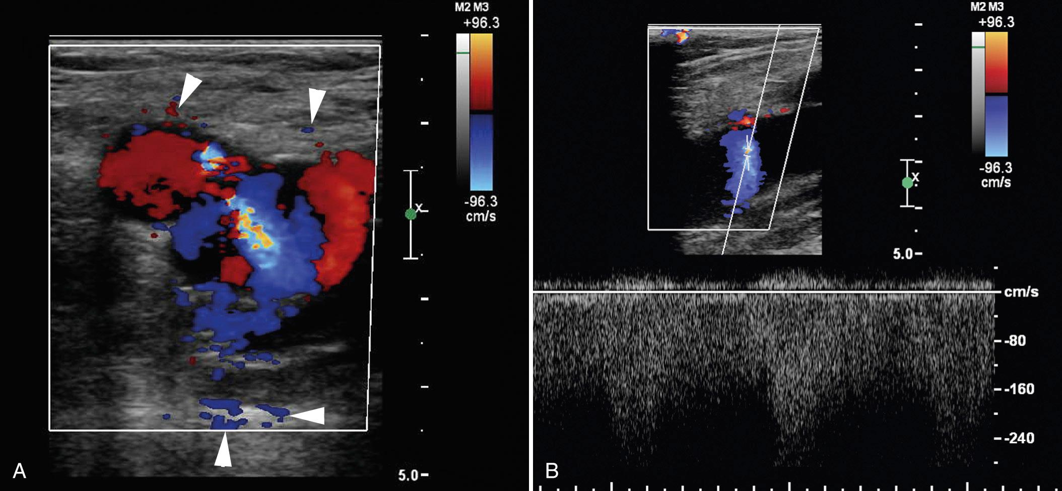 FIG. 27.14, Common Femoral Artery to Common Femoral Vein Arteriovenous Fistula (AVF).