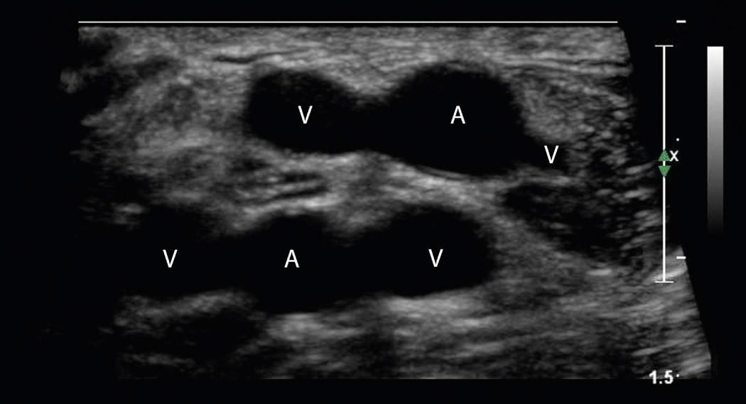 FIG. 27.16, High Brachial Artery Bifurcation.