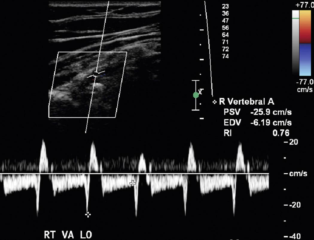 FIG. 27.20, Subclavian Steal With Transient Flow Reversal in the Vertebral Artery.