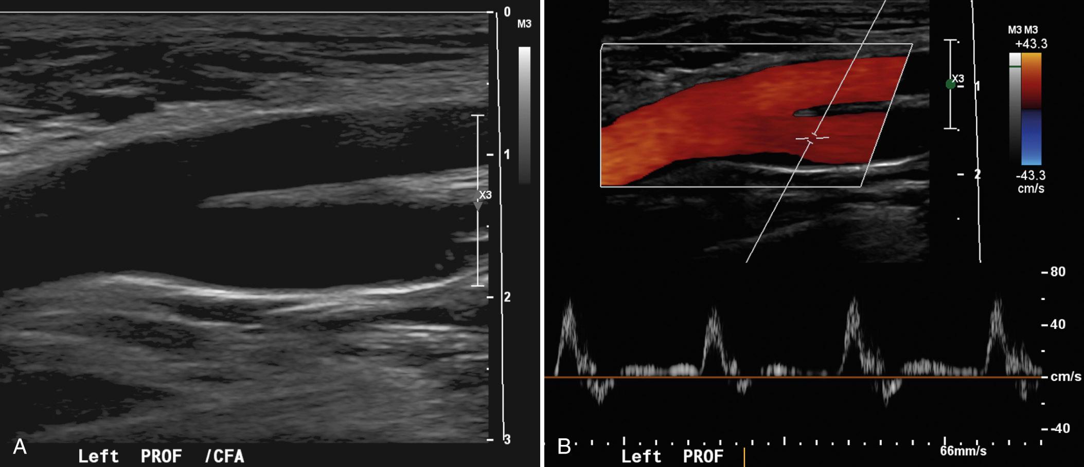 FIG. 27.2, Normal Common Femoral Artery Bifurcation.