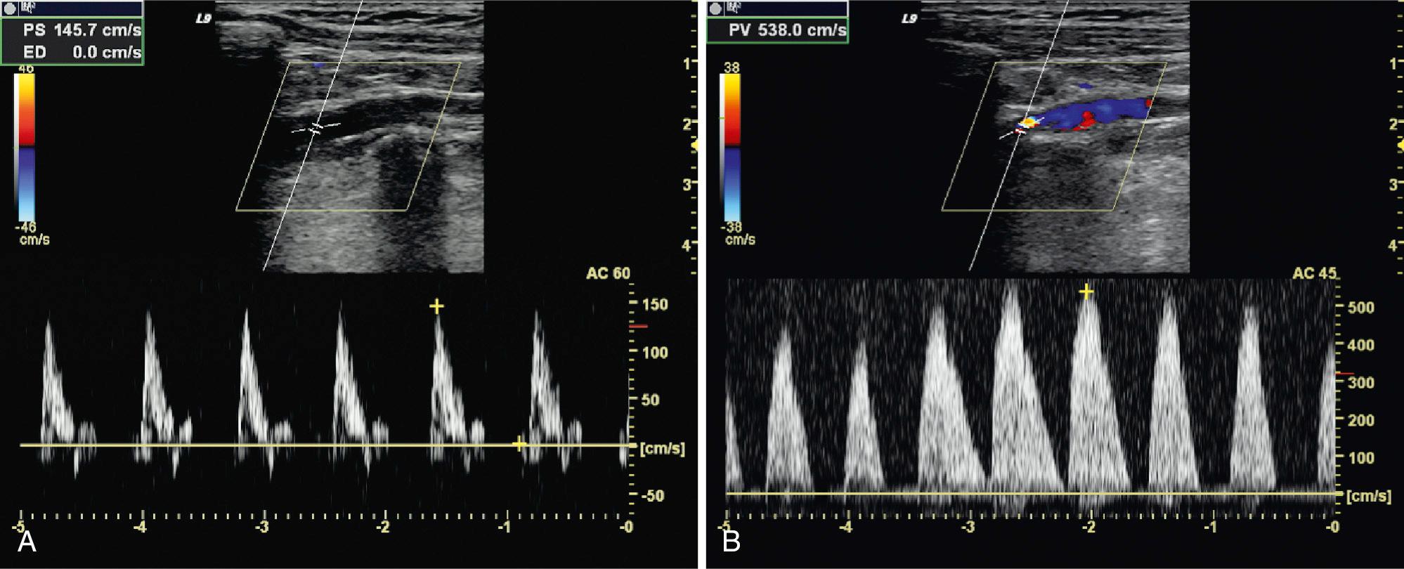 FIG. 27.21, Thoracic Outlet Syndrome.