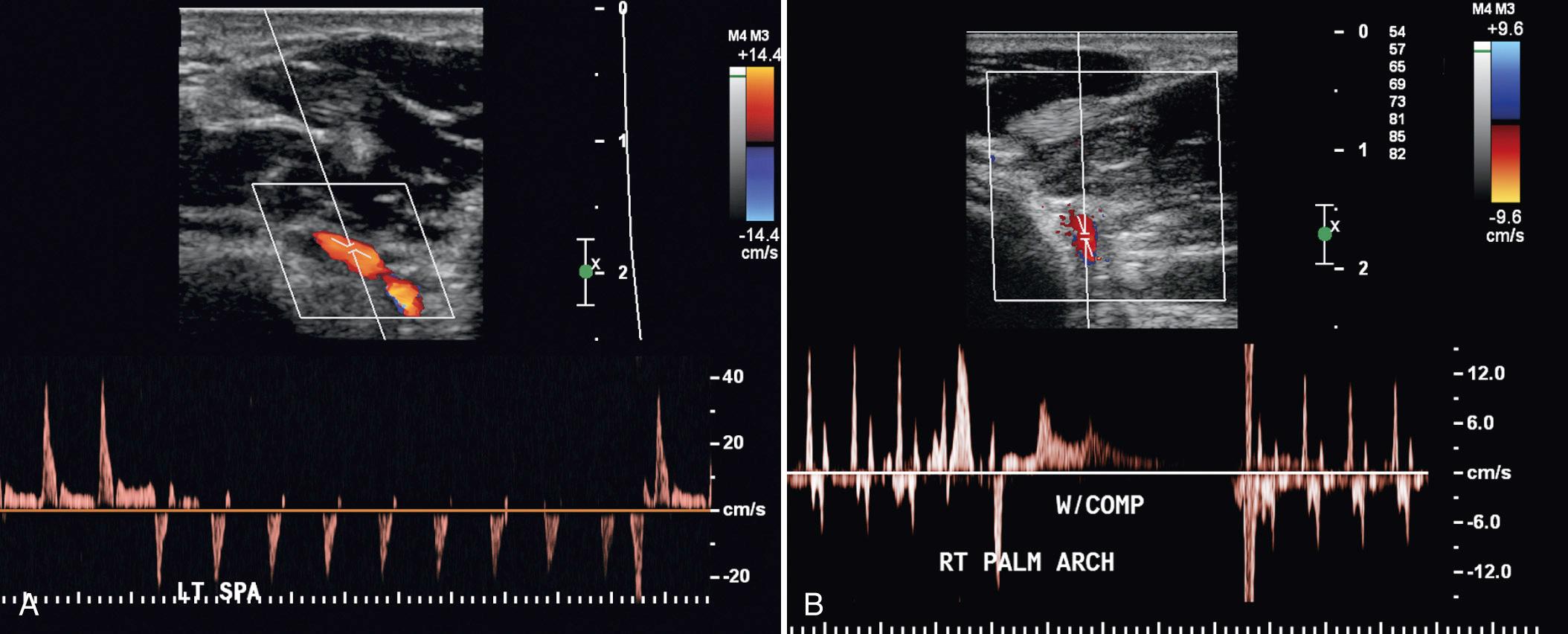 FIG. 27.22, Radial Artery Evaluation for Coronary Bypass Graft.