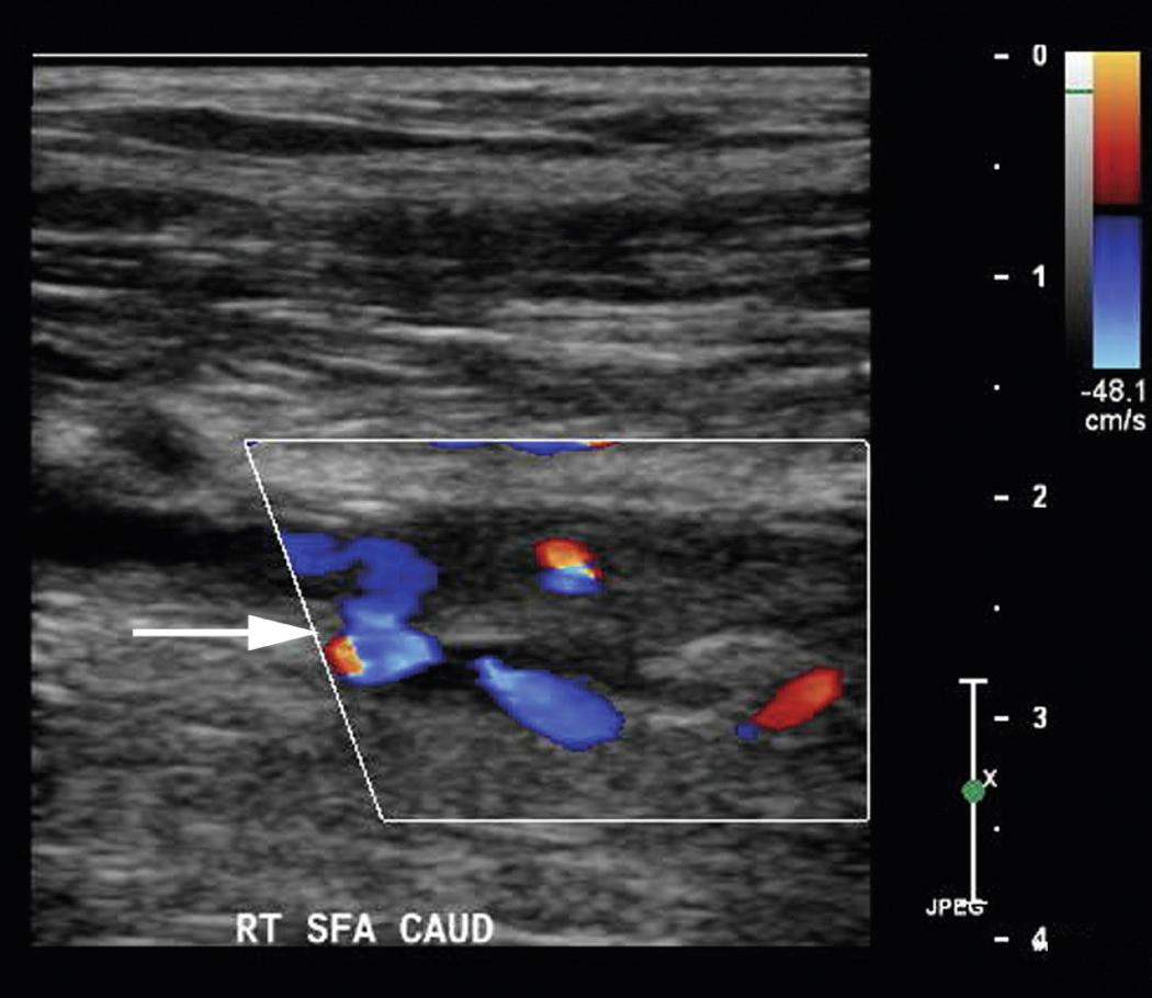 FIG. 27.5, Occlusion of the Superficial Femoral Artery With a Large Collateral Exiting Proximal to the Occlusion (Arrow).