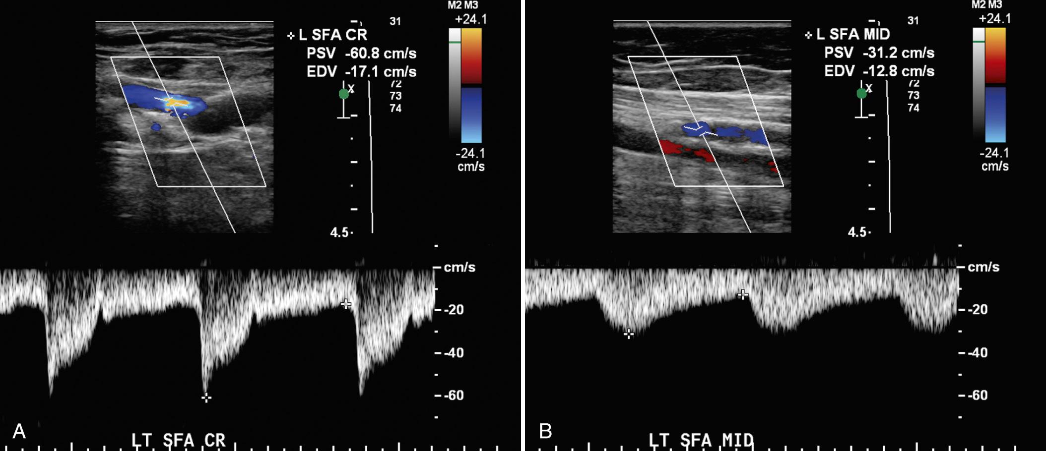 FIG. 27.7, Focal High-Grade Stenosis in the Proximal Superficial Femoral Artery (SFA).