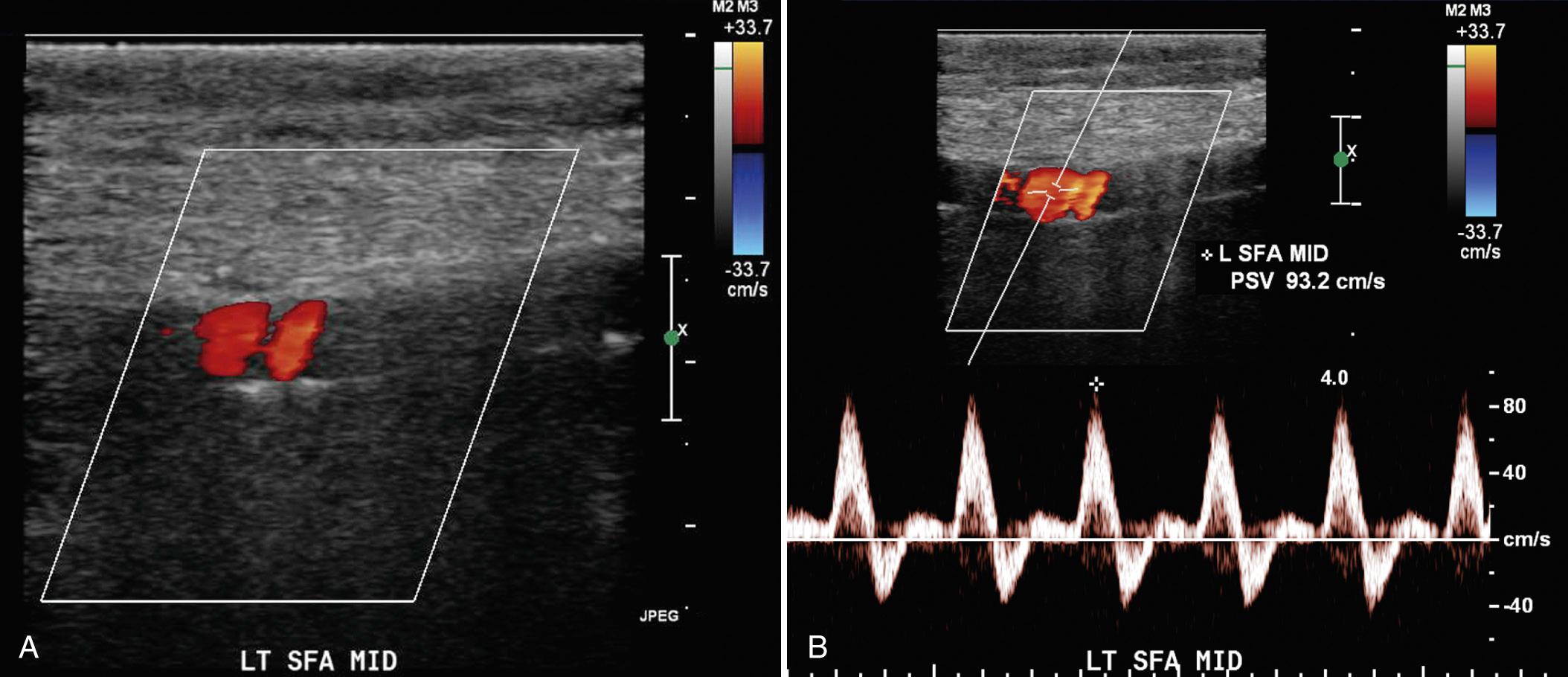 FIG. 27.8, Calcification of the Superficial Femoral Artery (SFA).