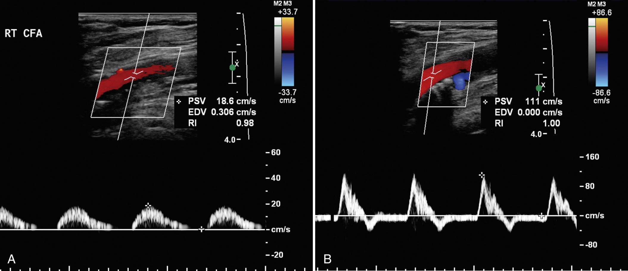 FIG. 27.10, Iliac Artery Stenosis With Tardus Parvus Waveform.