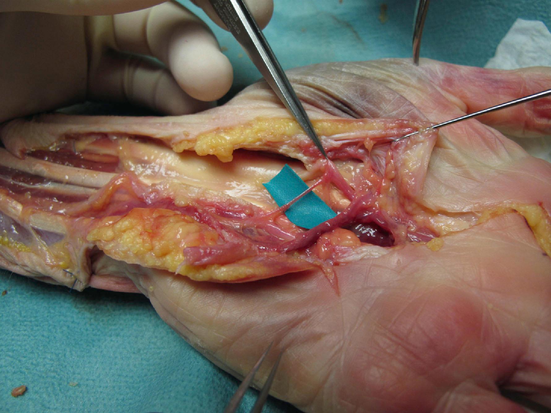 Figure 22.3, An anatomical preparation of the palmar communicating branch according to Berrettini in the palm. This variable, although common, anastomosis between the median nerve and the deep ulnar nerve provides a potential pathway for variation in area of finger skin innervation.