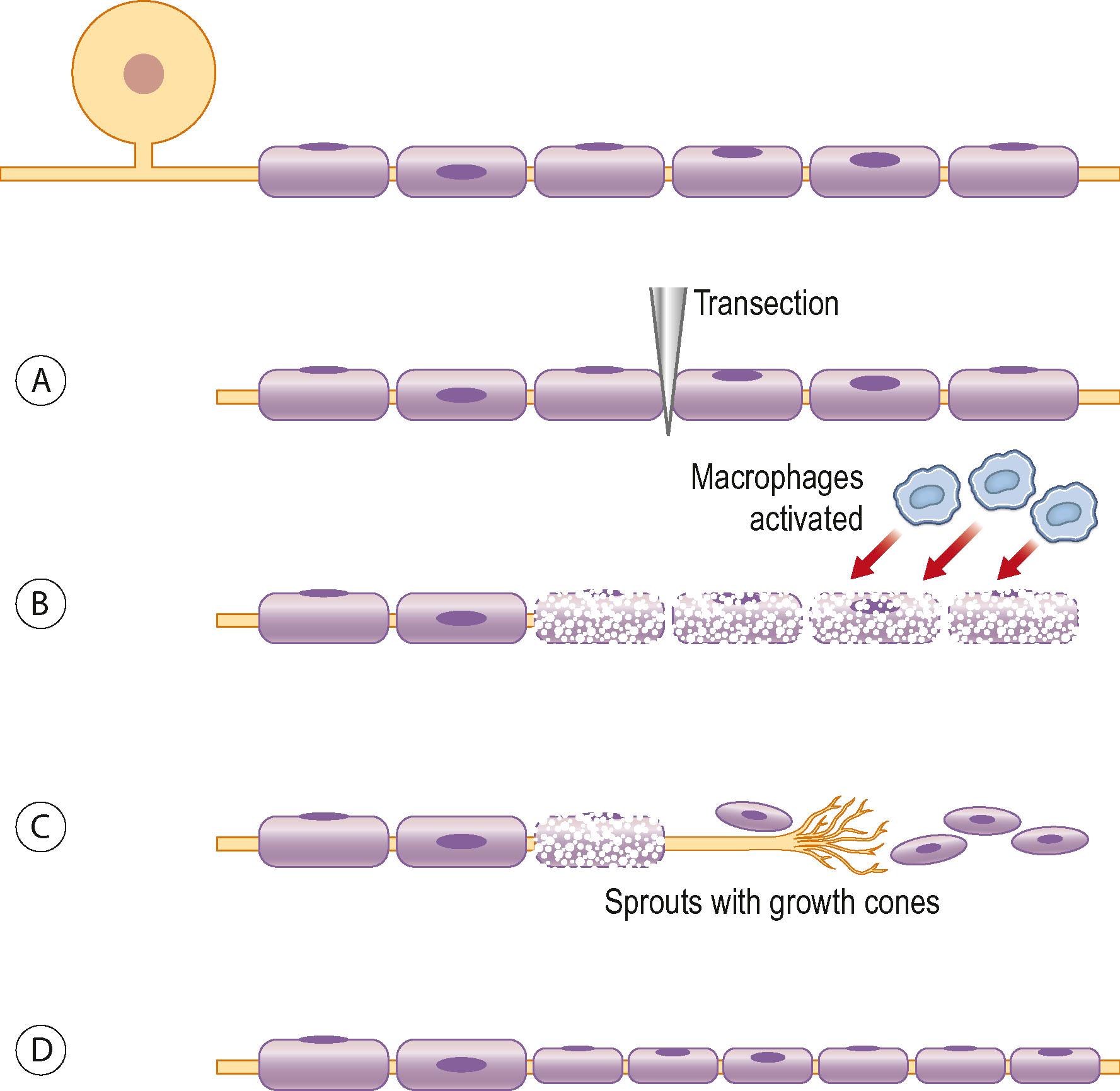 Figure 22.7, As the nerve is severed (A) , activated macrophages and Schwann cells will immediately start the removal of myelin and remnants of the disintegrated axon, to allow for a conducive environment for the regenerating axons (B) . Within just a few hours numerous sprouts emerge from the distal part of each axon and form the sprout growth cone that will guide the regeneration process distally (C) , until nerve regeneration is complete (D) .