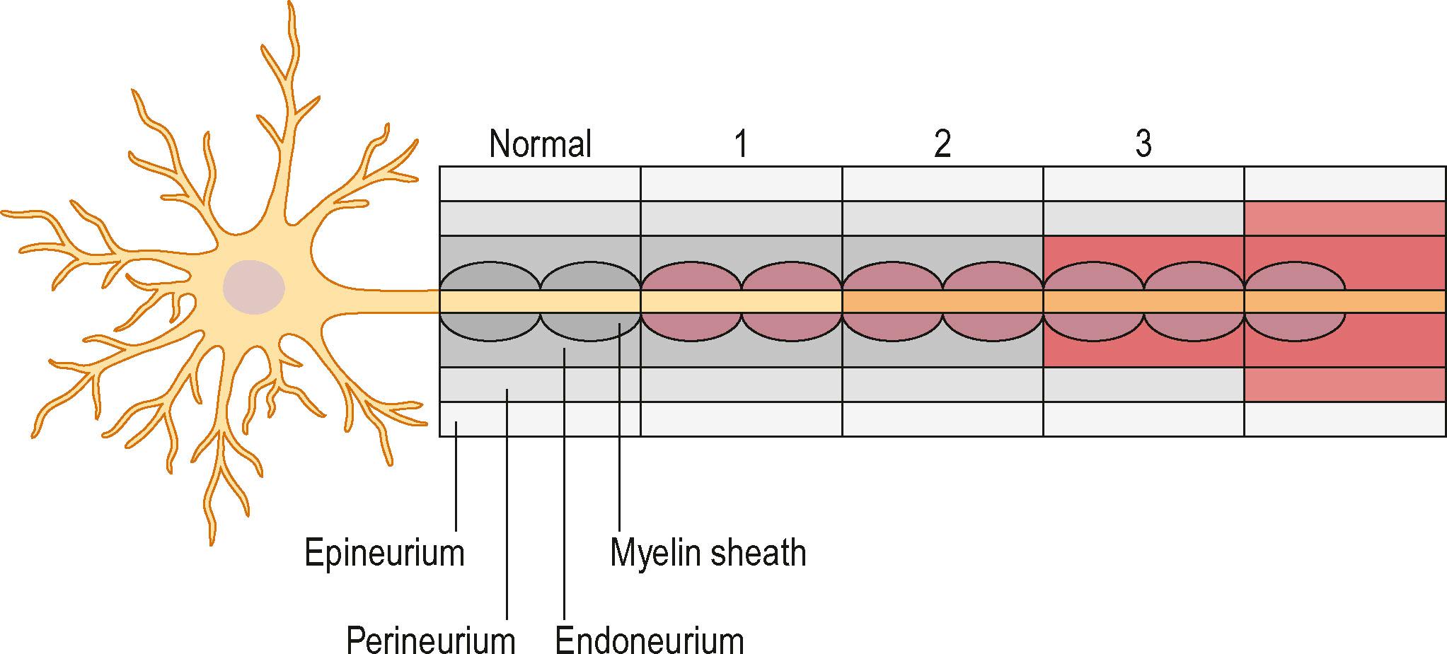 Figure 22.8, Schematic of damaged structures within an axon according to the classification of Sunderland grades 1–5. Change in color (red) and pattern indicates damage to each structure. Yellow represents an axon and its neuron.