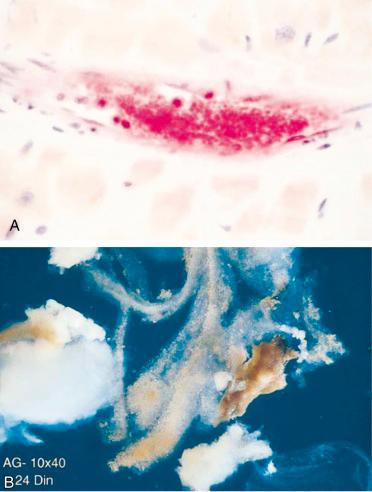 Fig. 30.2, (A) Histologic specimen of intramyocardial microvessel filled with platelets; the specimen stained positive for platelet glycoprotein IIb/IIIa from a patient who suffered sudden cardiac death. (B) Atherosclerotic particulate embolic material retrieved from percutaneous coronary revascularization with an Angioguard guidewire filter.