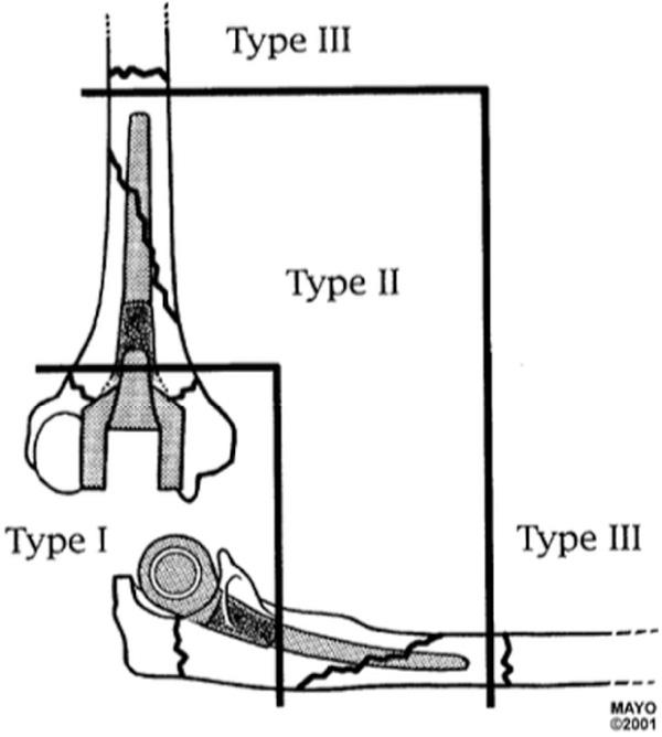 FIG 103.1, Mayo classification of periprosthetic elbow fractures.