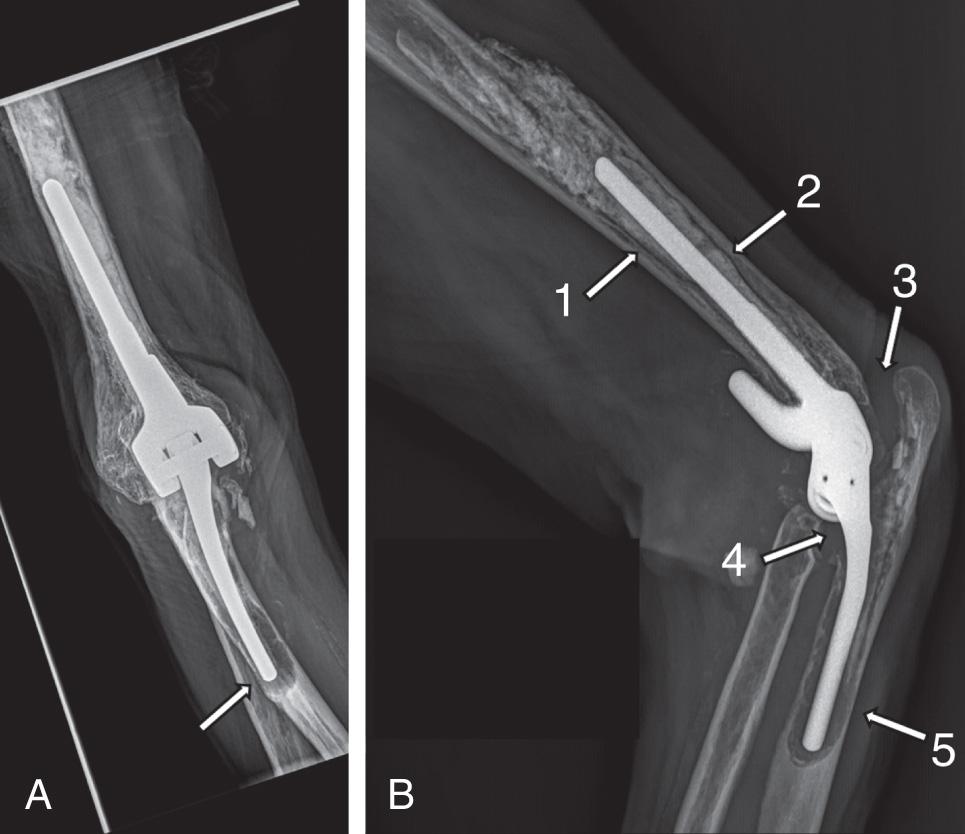 FIG 103.2, X-ray evaluation. (A) Anteroposterior view showing severe ulnar loosening and osteolysis, with impending lateral cortex fracture at the tip of the stem (arrow) . (B) Lateral view of same case showing radiolucent lines around the humeral stem (arrows 1 and 2) , distal ulnar implant migration (arrow 3) , anterior ulnar cortex insufficiency and fracture (arrow 4) , and impending posterior ulnar cortex fracture at the tip of the stem ( arrow 5, ulnar type II, subtype 3). (C) Periprosthetic humeral fracture at the tip of the stem, with cement mantle fracture, radiolucency anteriorly and posteriorly, and a thin and brittle humeral cortical area (humeral type II, subtype 3).