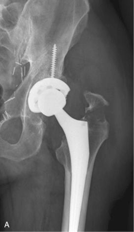 Fig. 107.3, Periprosthetic femoral fracture type A G (A) and after nonoperative treatment (B).