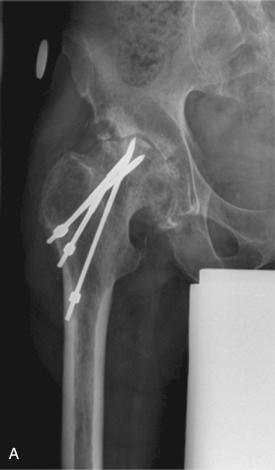 Fig. 107.4, Periprosthetic femoral fracture type A G due through the bony defects from pins that were removed at the time of arthroplasty. The greater trochanter fracture was treated with operative stabilization. (A) Preoperative. (B) Immediate postoperative. (C) Six weeks postoperatively. (D) Three months postfixation of the greater trochanter.