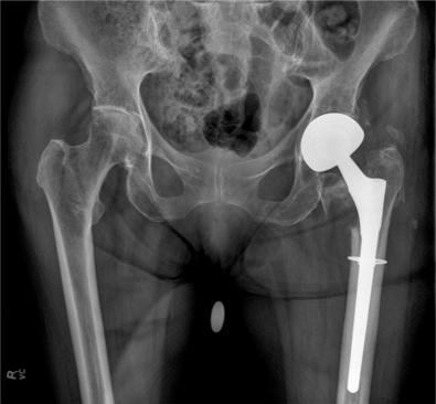 Fig. 107.5, Periprosthetic femoral fracture type A L with extension into the subtrochanteric region.